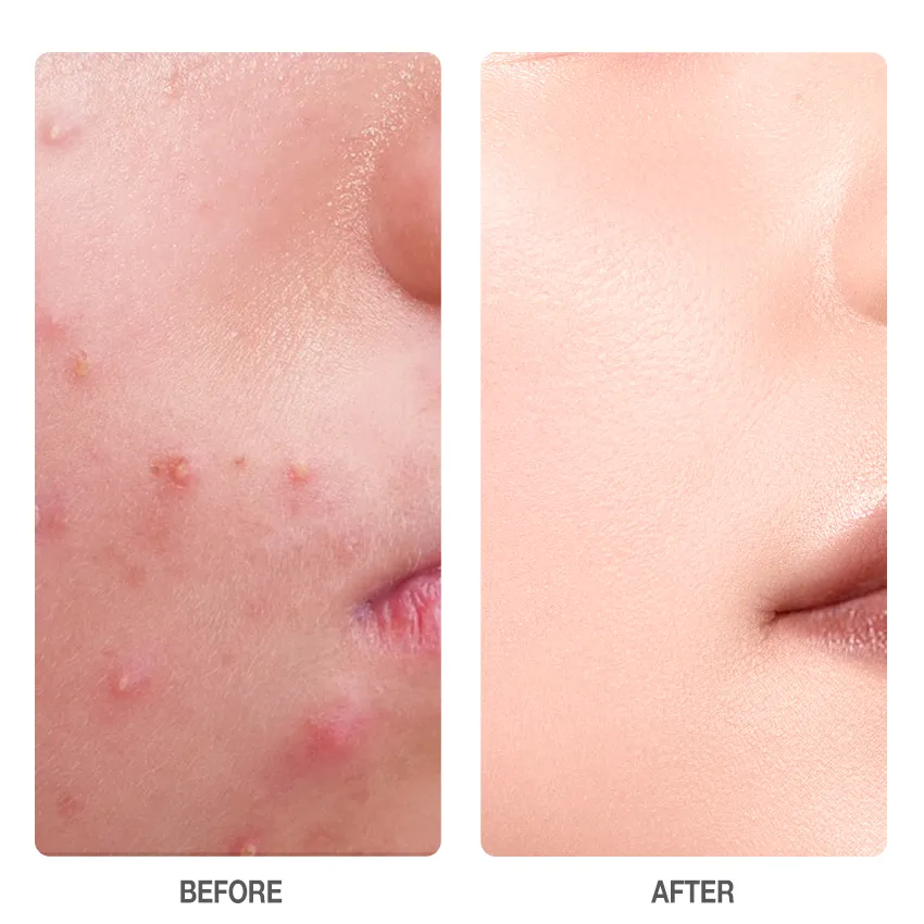 SKINEVER - SALICYLIC ACID Refreshing ACNE SOAP 80g